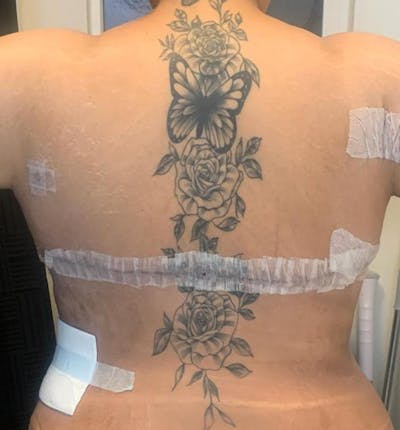 Bra Line Back Lift ™ Before & After Gallery - Patient 348485 - Image 2
