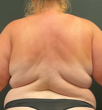 Bra Line Back Lift ™ Before & After Gallery - Patient 132050 - Image 1