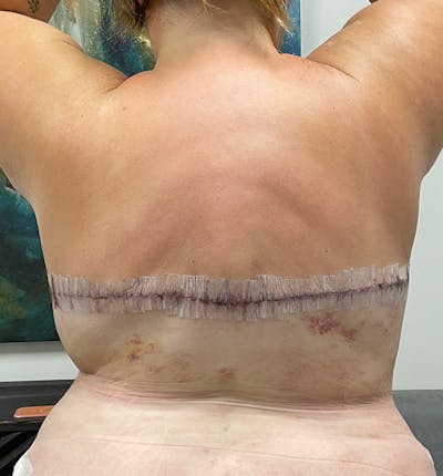 Bra Line Back Lift ™ Before & After Gallery - Patient 132050 - Image 2