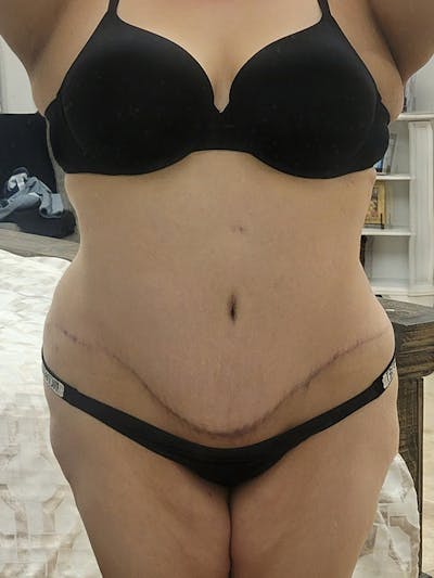 Plus Size Tummy Tuck ® Before & After Gallery - Patient 400138 - Image 2
