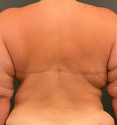 Bra Line Back Lift ™ Before & After Gallery - Patient 805394 - Image 2