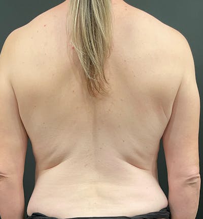 Bra Line Back Lift ™ Before & After Gallery - Patient 709076 - Image 1