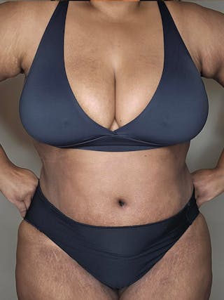 Plus Size Tummy Tuck ® Before & After Gallery - Patient 398093 - Image 2