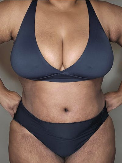 Plus Size Tummy Tuck ® Before & After Gallery - Patient 398093 - Image 2