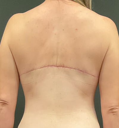 Bra Line Back Lift ™ Before & After Gallery - Patient 709076 - Image 2