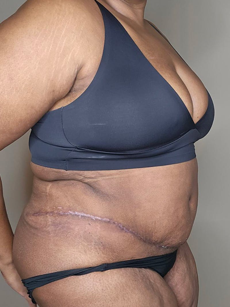 Plus Size Tummy Tuck ® Before & After Gallery - Patient 398093 - Image 4