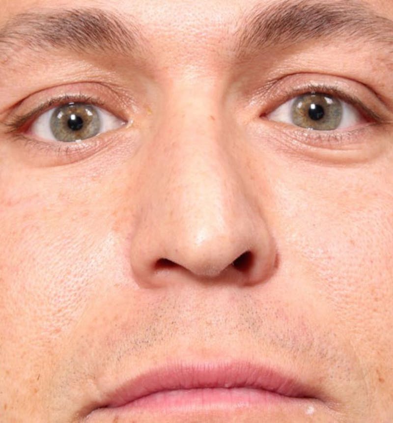 Non-Surgical Rhinoplasty Before & After Gallery - Patient 138805 - Image 3