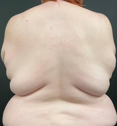 Bra Line Back Lift ™ Before & After Gallery - Patient 120204 - Image 1