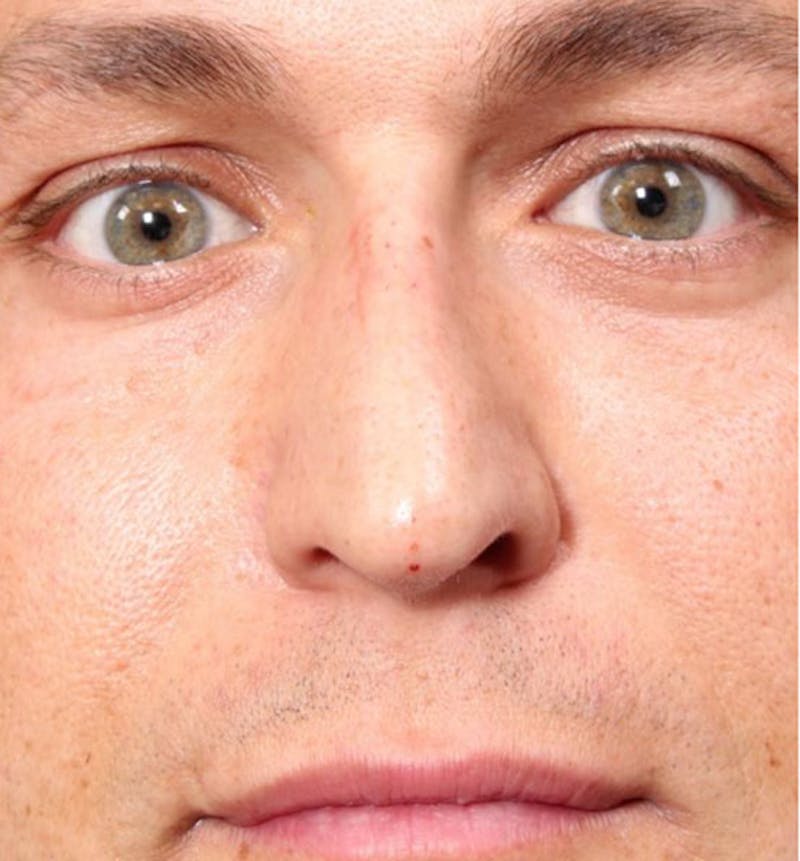 Non-Surgical Rhinoplasty Before & After Gallery - Patient 138805 - Image 4