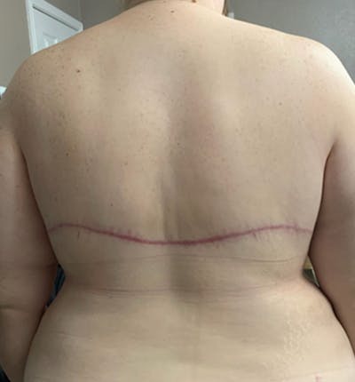 Bra Line Back Lift ™ Before & After Gallery - Patient 120204 - Image 2
