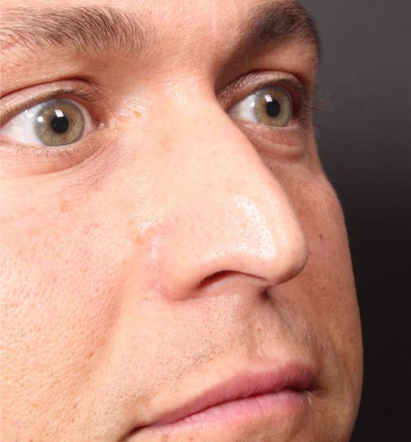 Non-Surgical Rhinoplasty Before & After Gallery - Patient 138805 - Image 5
