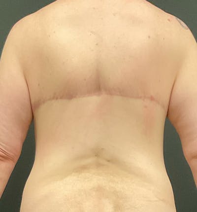 Bra Line Back Lift ™ Before & After Gallery - Patient 367890 - Image 2