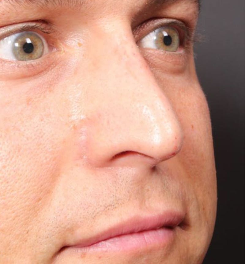 Non-Surgical Rhinoplasty Before & After Gallery - Patient 138805 - Image 6