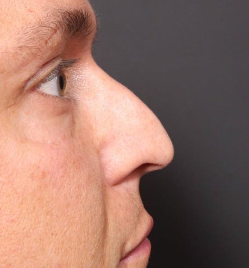 Non-Surgical Rhinoplasty Before & After Gallery - Patient 138805 - Image 7