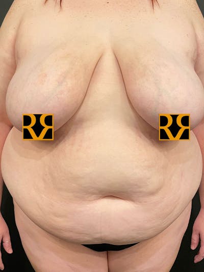 Plus Size Tummy Tuck ® Before & After Gallery - Patient 733678 - Image 1