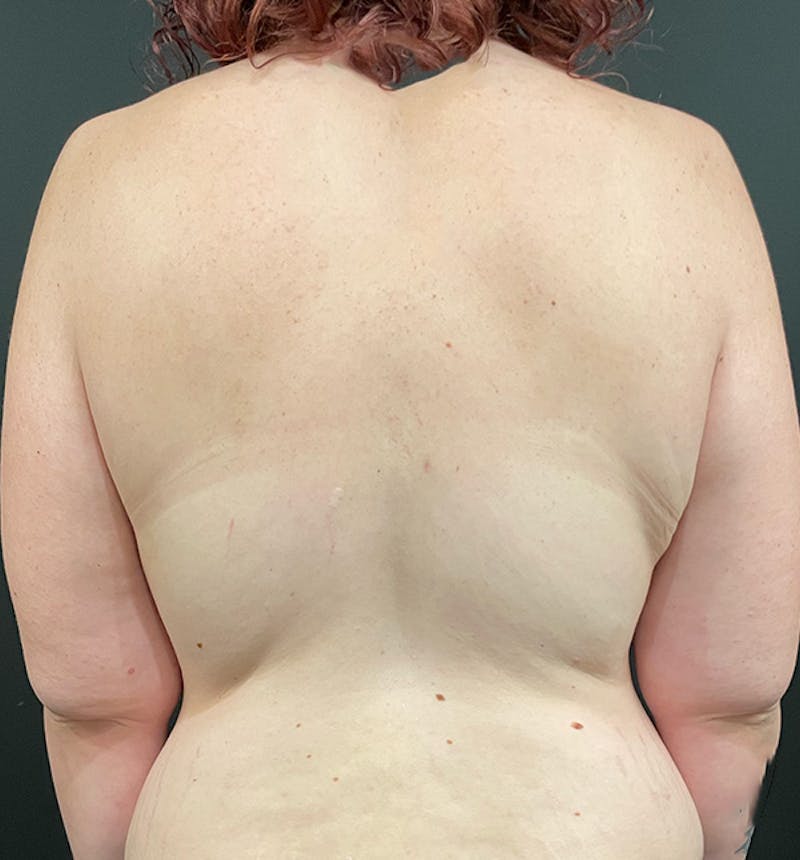 Bra Line Back Lift ™ Before & After Gallery - Patient 186299 - Image 1