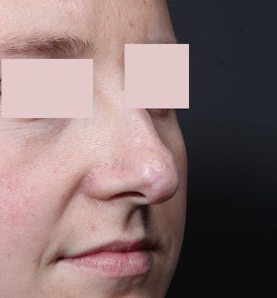 Rhinoplasty Before & After Gallery - Patient 130724 - Image 1