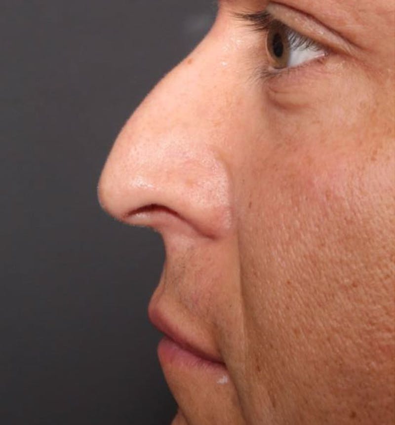 Non-Surgical Rhinoplasty Before & After Gallery - Patient 138805 - Image 9