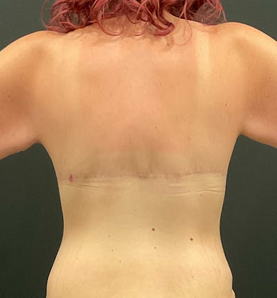 Bra Line Back Lift ™ Before & After Gallery - Patient 186299 - Image 2