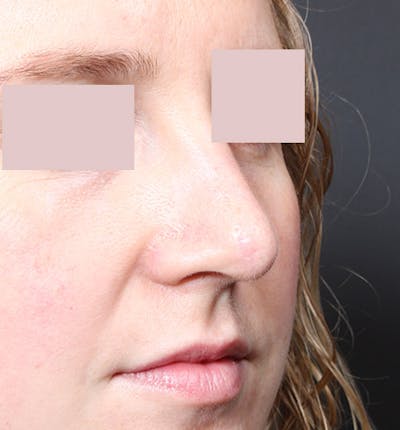 Rhinoplasty Before & After Gallery - Patient 130724 - Image 2