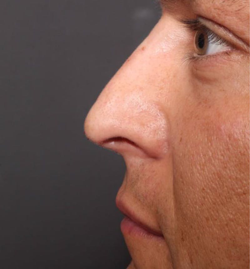 Non-Surgical Rhinoplasty Before & After Gallery - Patient 138805 - Image 10
