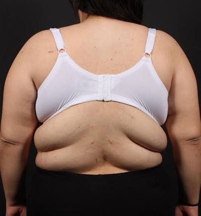 Bra Line Back Lift ™ Before & After Gallery - Patient 449900 - Image 1