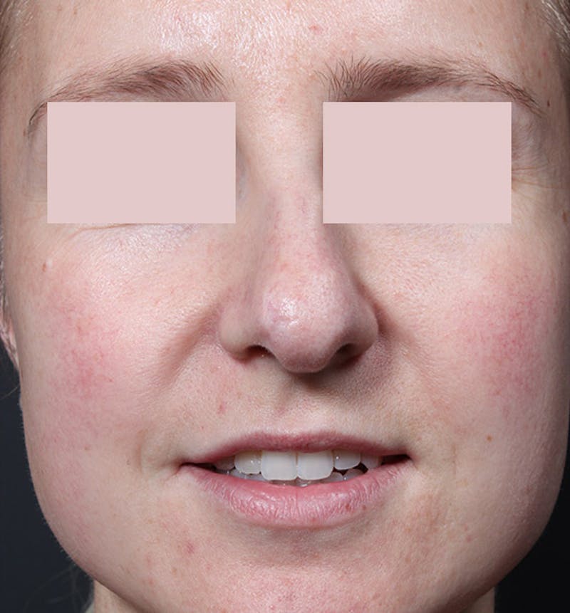 Rhinoplasty Before & After Gallery - Patient 130724 - Image 3