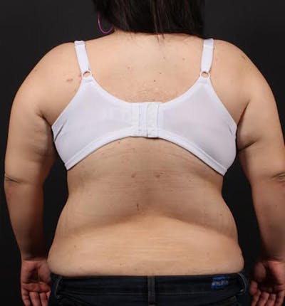 Bra Line Back Lift ™ Before & After Gallery - Patient 449900 - Image 2