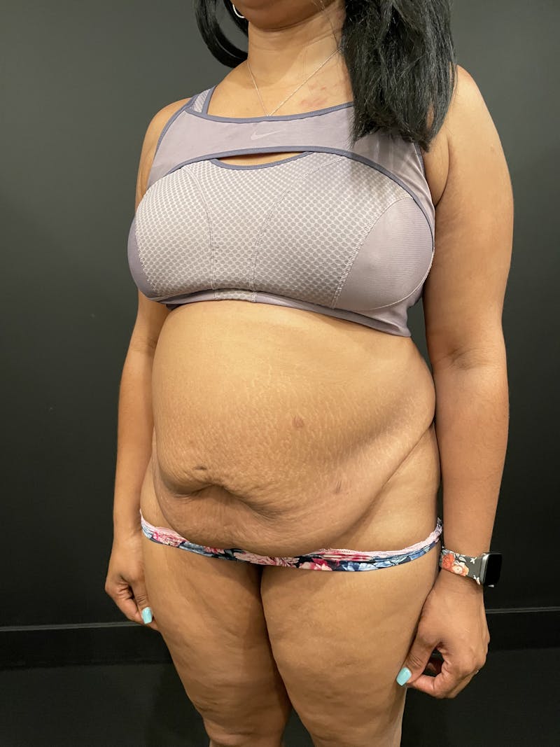Tummy Tuck Before & After Gallery - Patient 435850 - Image 7