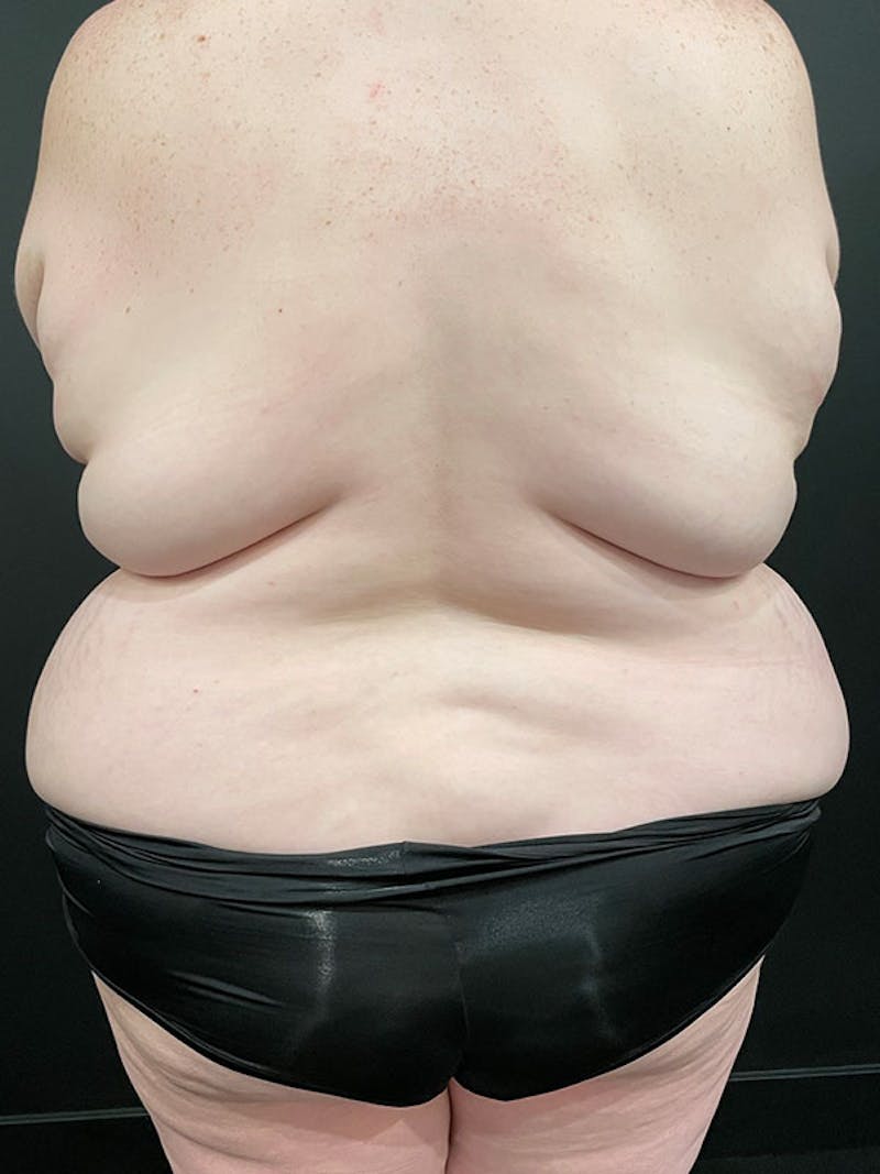 Plus Size Tummy Tuck ® Before & After Gallery - Patient 733678 - Image 5