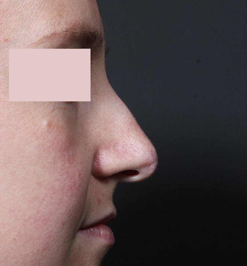 Rhinoplasty Before & After Gallery - Patient 130724 - Image 5