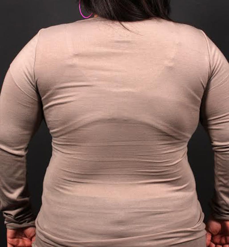 Bra Line Back Lift ™ Before & After Gallery - Patient 449900 - Image 4