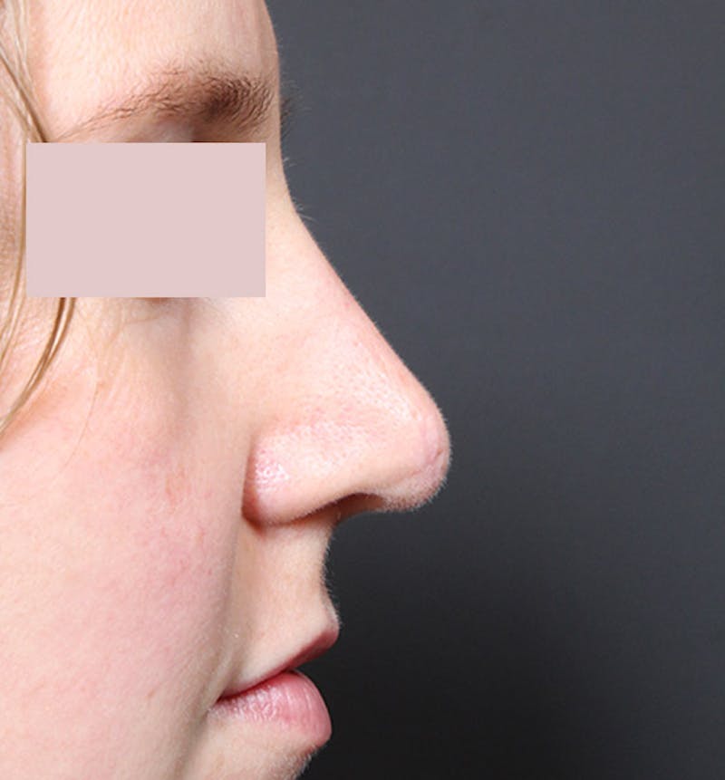 Rhinoplasty Before & After Gallery - Patient 130724 - Image 6