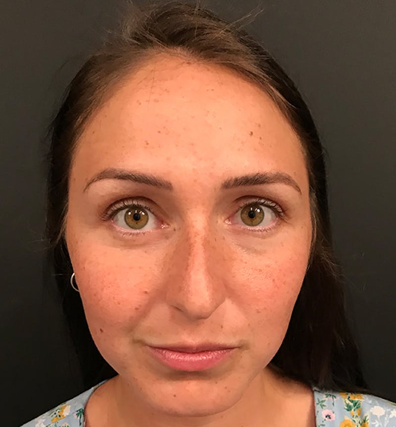 Non-Surgical Rhinoplasty Before & After Gallery - Patient 477841 - Image 3