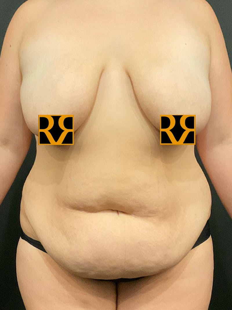 Plus Size Tummy Tuck ® Before & After Gallery - Patient 916609 - Image 1