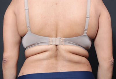 Bra Line Back Lift ™ Before & After Gallery - Patient 209358 - Image 1