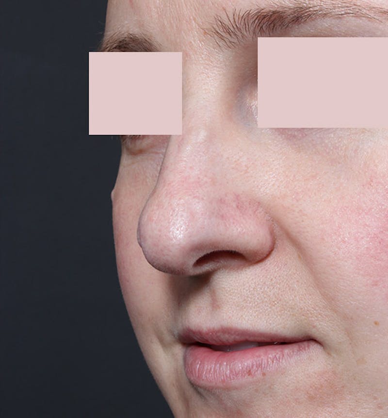 Rhinoplasty Before & After Gallery - Patient 130724 - Image 7