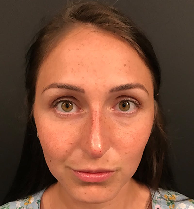 Non-Surgical Rhinoplasty Before & After Gallery - Patient 477841 - Image 4