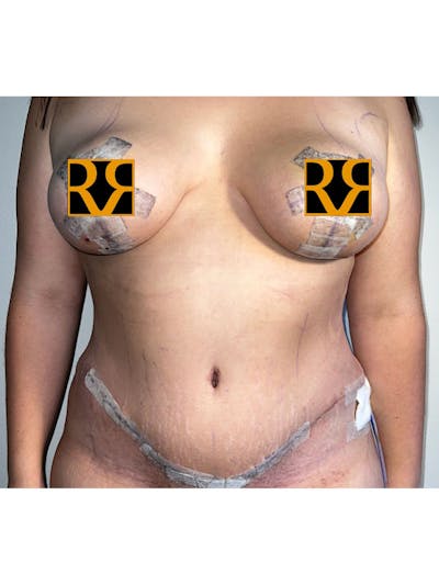 Plus Size Tummy Tuck ® Before & After Gallery - Patient 916609 - Image 2