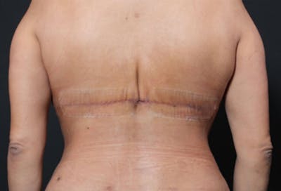 Bra Line Back Lift ™ Before & After Gallery - Patient 209358 - Image 2