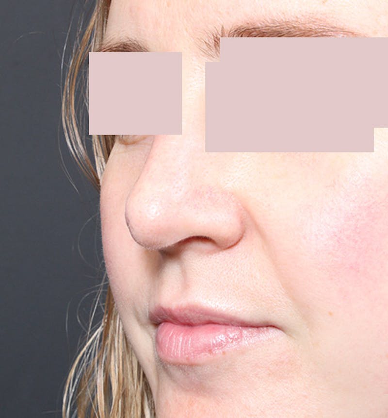 Rhinoplasty Before & After Gallery - Patient 130724 - Image 8