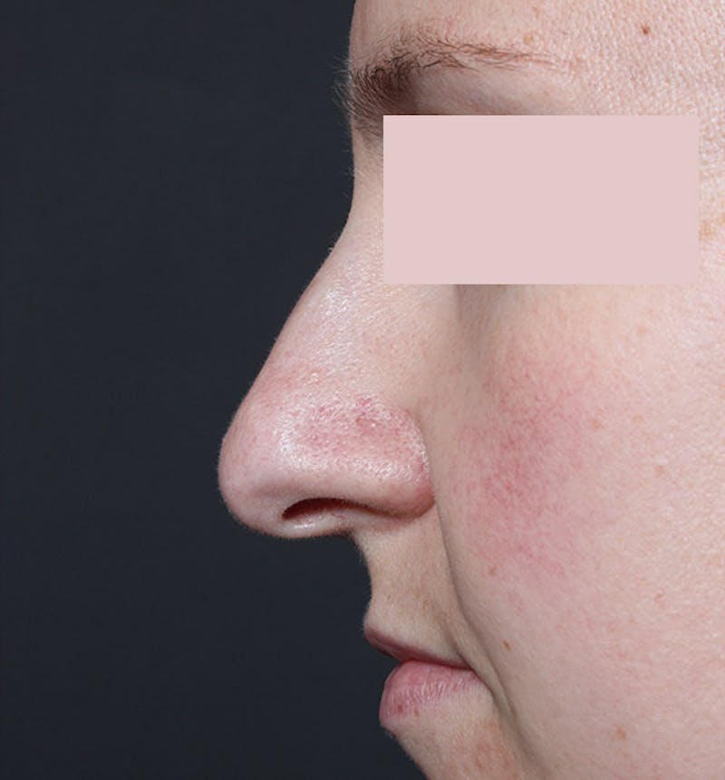 Rhinoplasty Before & After Gallery - Patient 130724 - Image 9