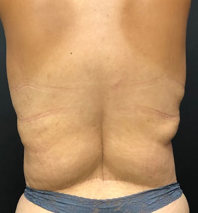 Bra Line Back Lift ™ Before & After Gallery - Patient 882863 - Image 1