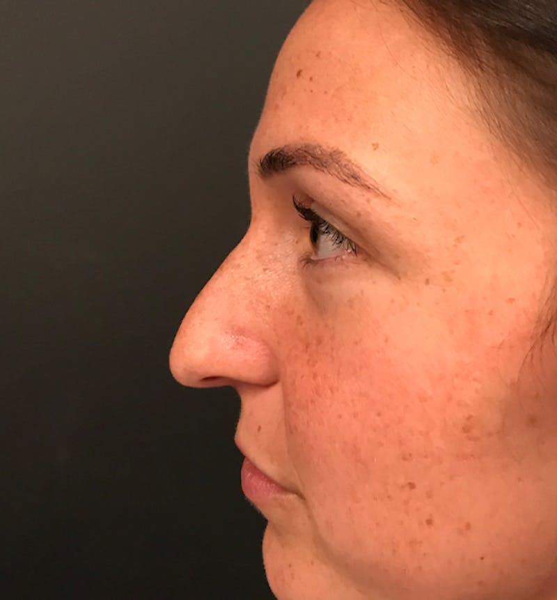 Non-Surgical Rhinoplasty Before & After Gallery - Patient 477841 - Image 5