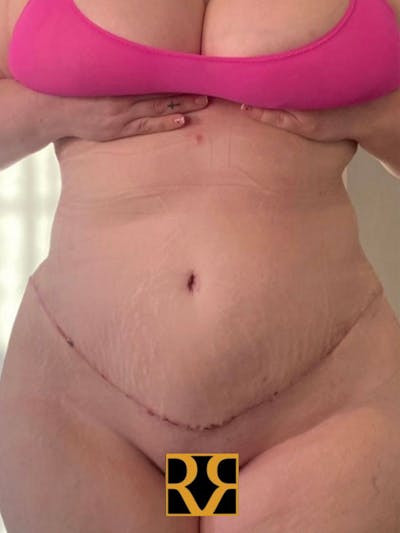 Plus Size Tummy Tuck ® Before & After Gallery - Patient 369933 - Image 2