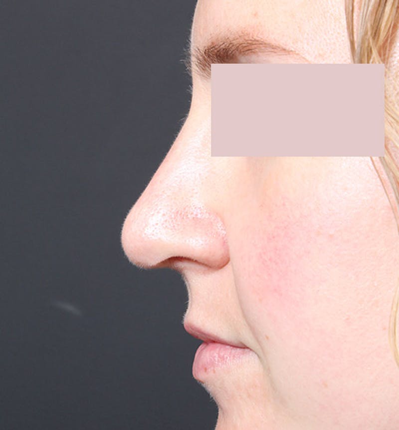 Rhinoplasty Before & After Gallery - Patient 130724 - Image 10