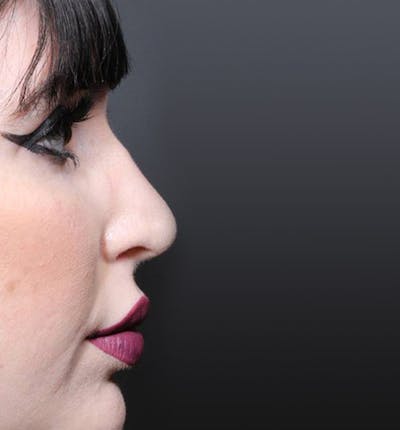 Rhinoplasty Before & After Gallery - Patient 143669 - Image 2