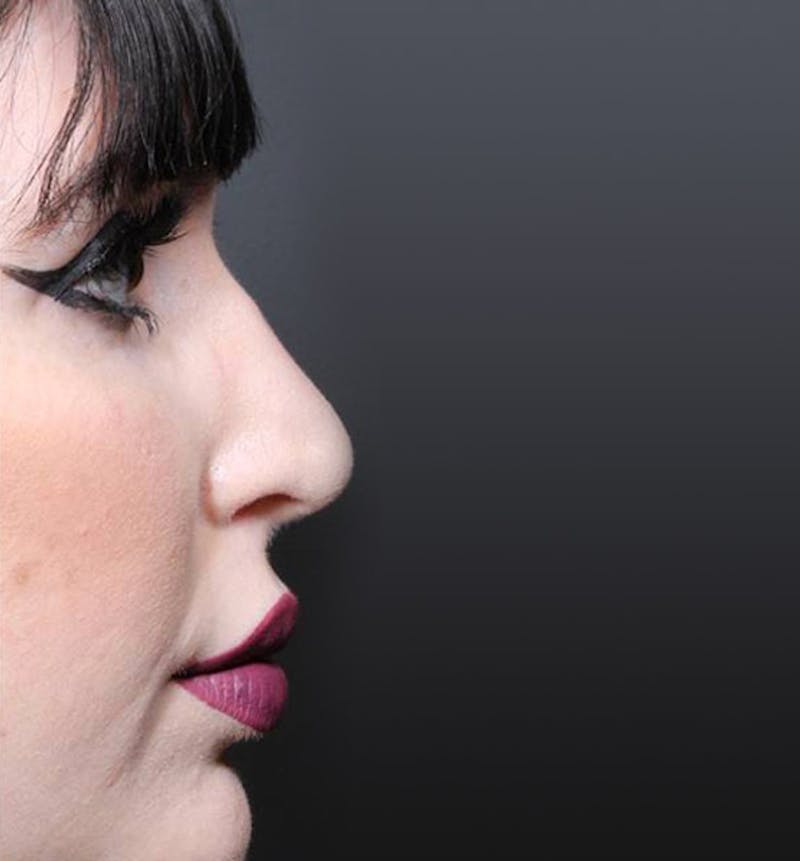 Rhinoplasty Before & After Gallery - Patient 143669 - Image 2