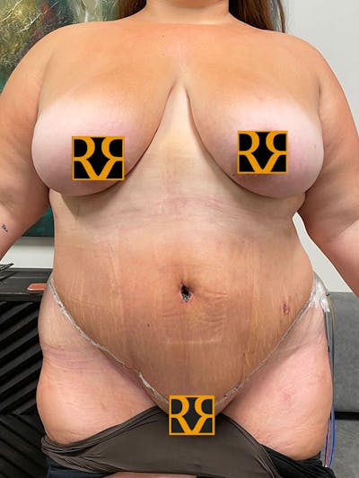 Plus Size Tummy Tuck: Week After Surgery Before & After Gallery - Patient 330083 - Image 2