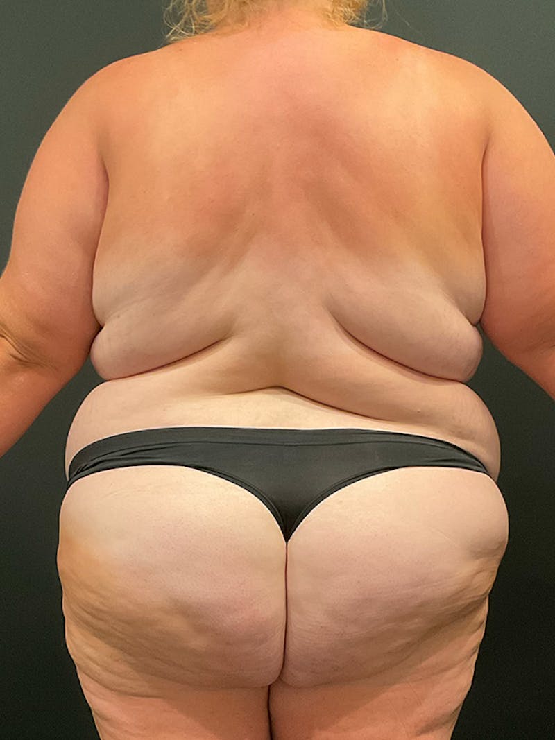 Plus Size Tummy Tuck: Week After Surgery Before & After Gallery - Patient 330083 - Image 3